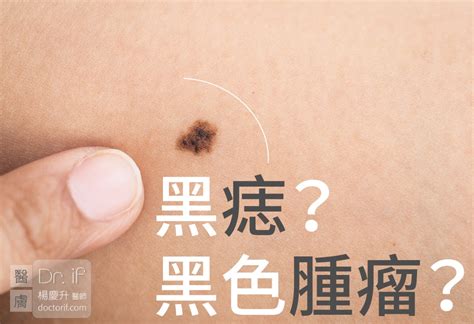 身體的痣|痣是什麼？一次了解痣原因、就醫時機以及如何改善